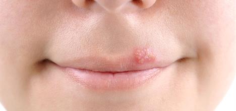 Best Natural Ways to Treat Cold Sores