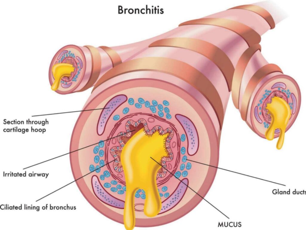 Cure Bronchitis Naturally:
