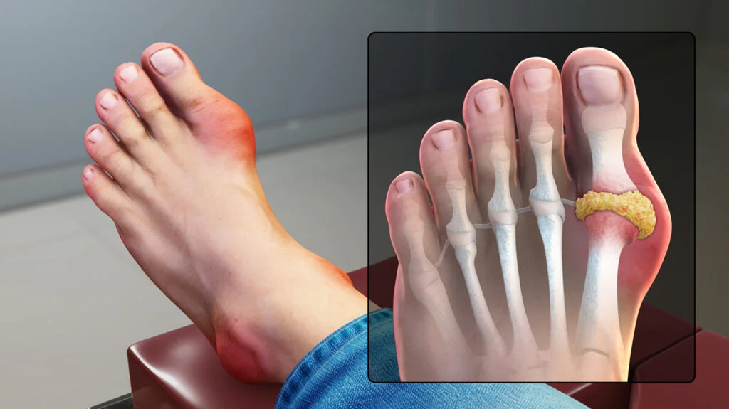 Get Rid of Gout Naturally