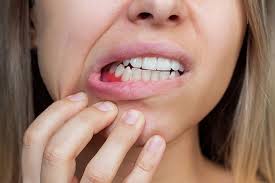 Natural Ways to Stop Bleeding Gums Fast