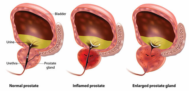 Shrink an Enlarged Prostate Naturally 