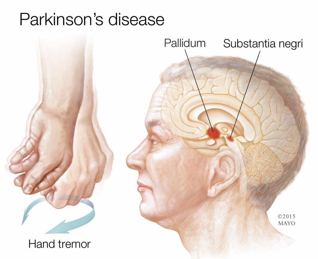 Natural Remedies for Parkinson’s Disease Without Medication