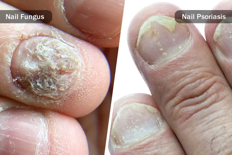 Cure Nail Psoriasis Naturally 