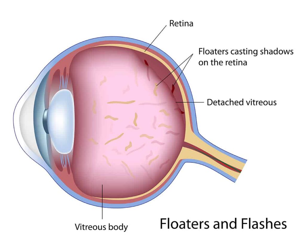 Dissolve Eye Floaters
